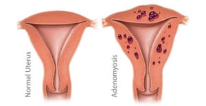 adenomyosis treatments and symptoms 